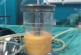 绵阳360度水动力吸脂费用多少钱？