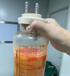 绵阳水动力吸脂手术要做多久？